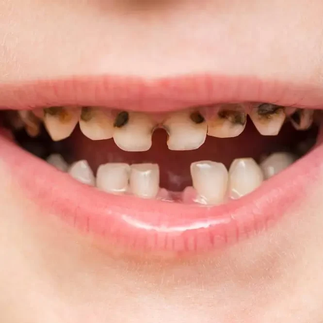 تسوس الأسنان : الاسباب والاعراض والعلاج