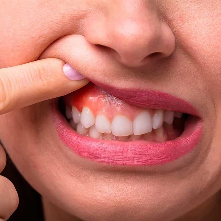 طرق تقوية اللثة : تعرف علي طرق العناية بصحة اللثة